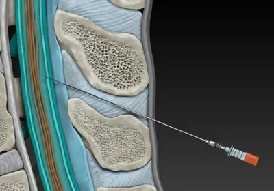 3D model of a spinal tap 3D model of a spinal tap